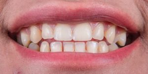 chip tooth