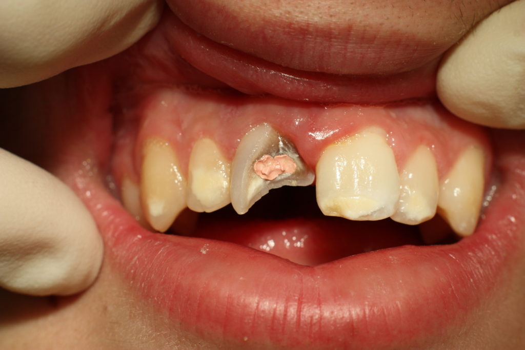 Dentist | Dental Procedures - Chipped Tooth | Brooklyn Blvd Dental, MN