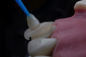 tooth chipping