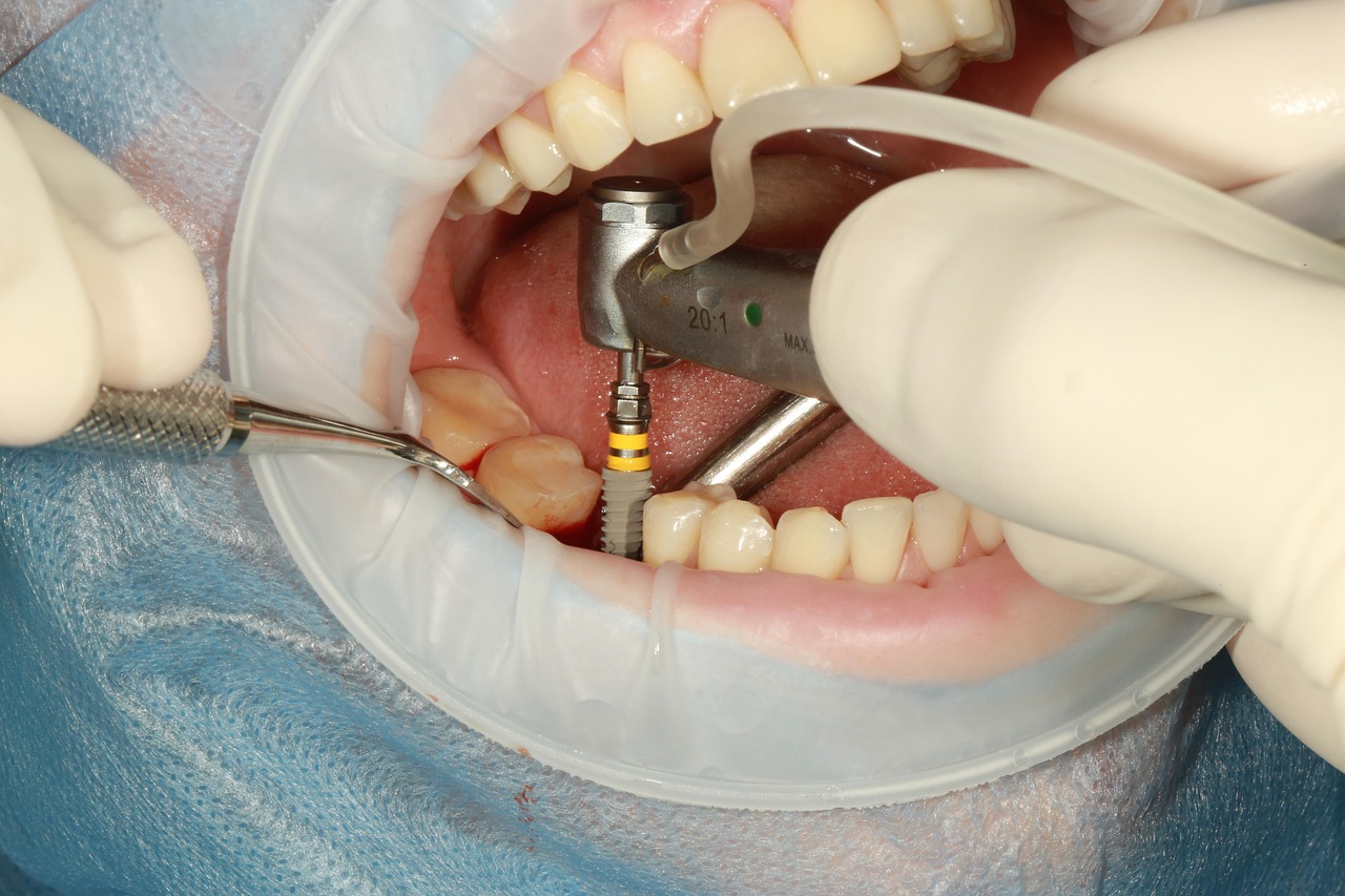 dental implant vs bridge