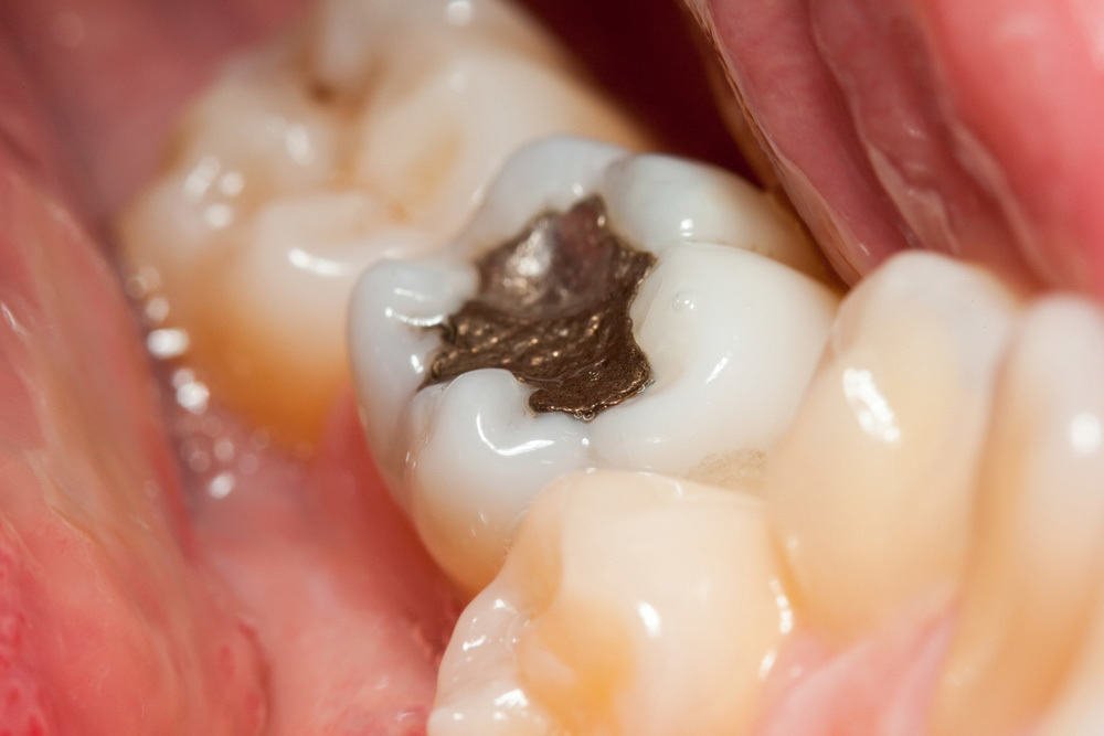 Tooth Fillings | Family Dentist in Brooklyn, MN | Brooklyn Blvd Dental