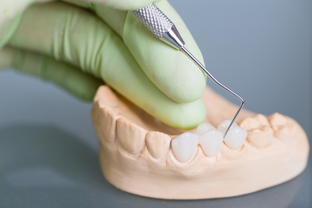 Bridges - Family Dentist Near You, Brooklyn | Brooklyn Blvd Dental, MN