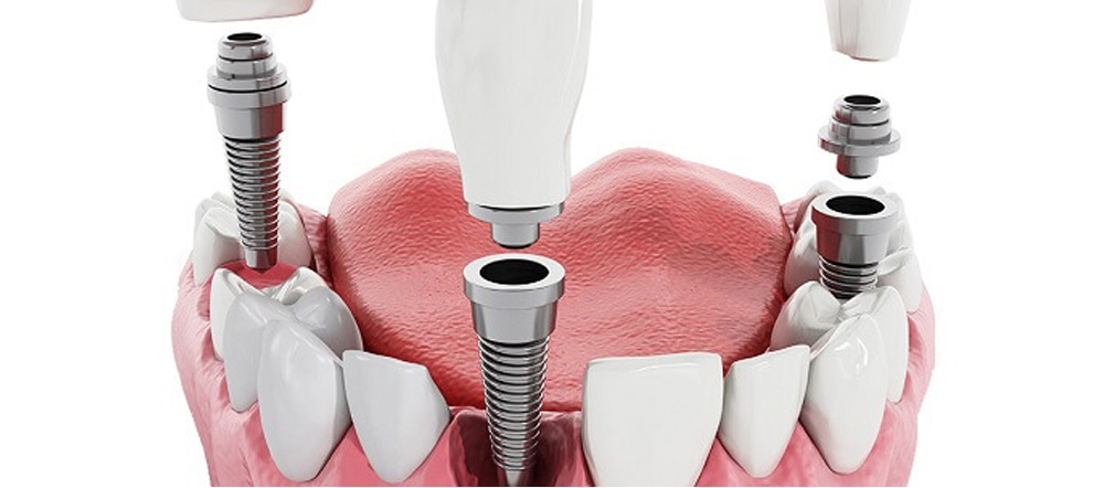 Dental Implants and Its Myths | Best Dentist at Brooklyn blvd dental