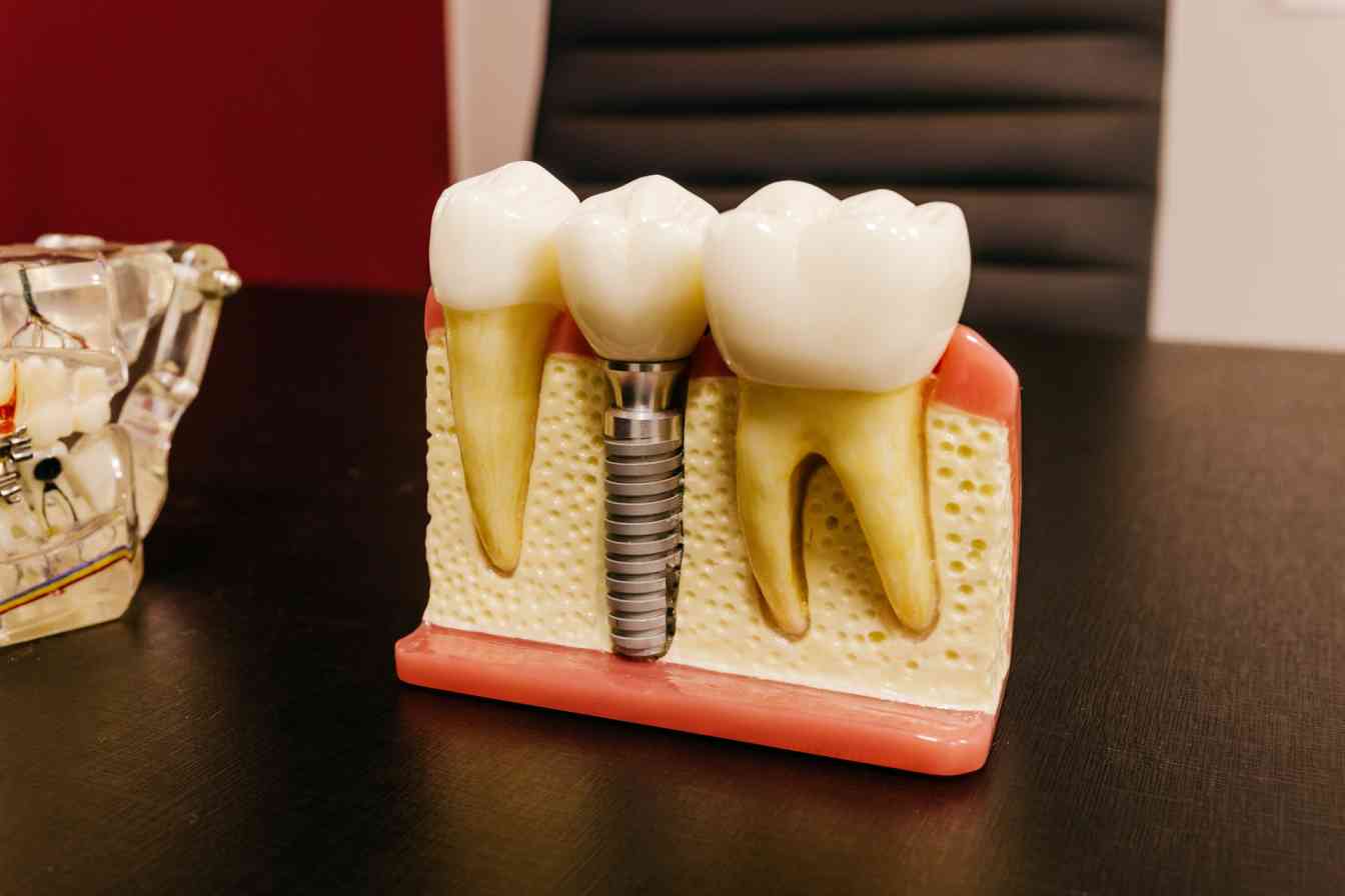 does-health-insurance-cover-dental-implants-surgery