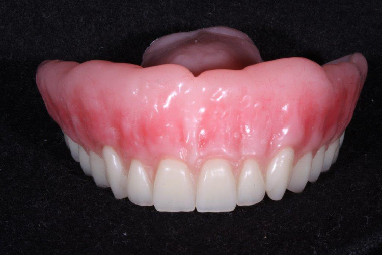 Upper Jaw Cosmetic Dentures at Brooklyn Blvd Dental, Brooklyn Center, MN