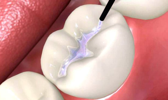 What are Dental Sealants ?