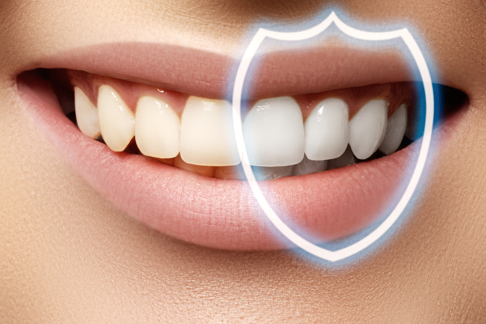 What is dental bonding ?