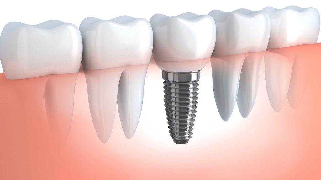 What are Dental implants ?