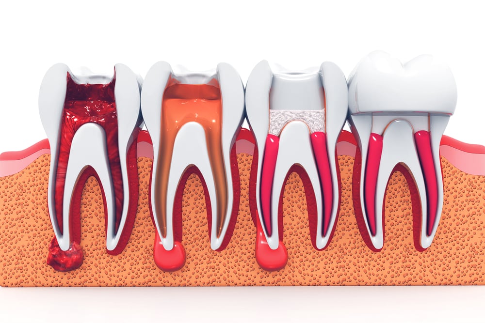 Different Stages of root canal therapy