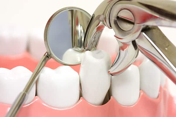 Process for Tooth extractions