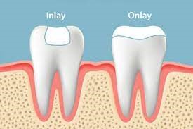 Inlays Onlays dental treatment