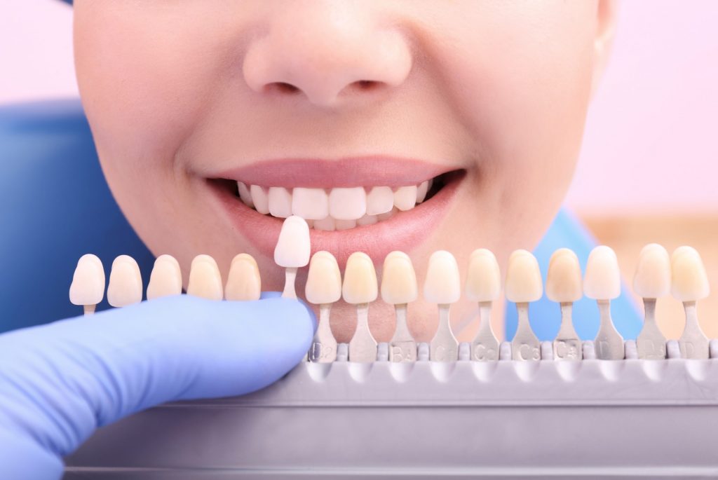 Tooth Coloured Fillings procedure