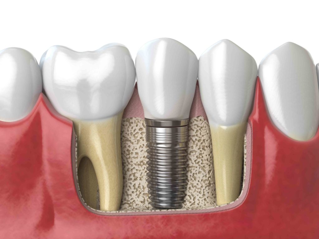 Dental crowns illustration