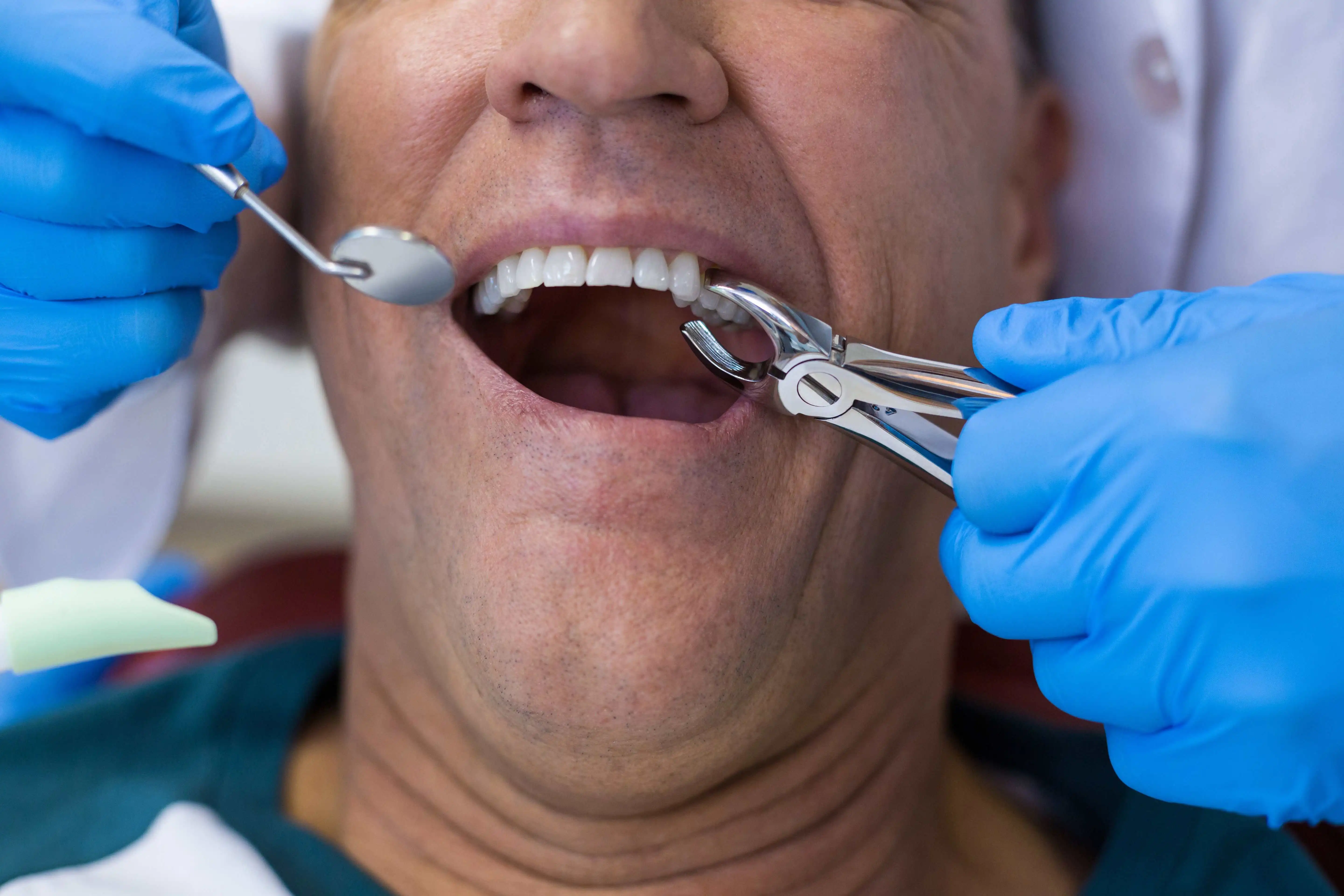 What to Do Tooth Extraction