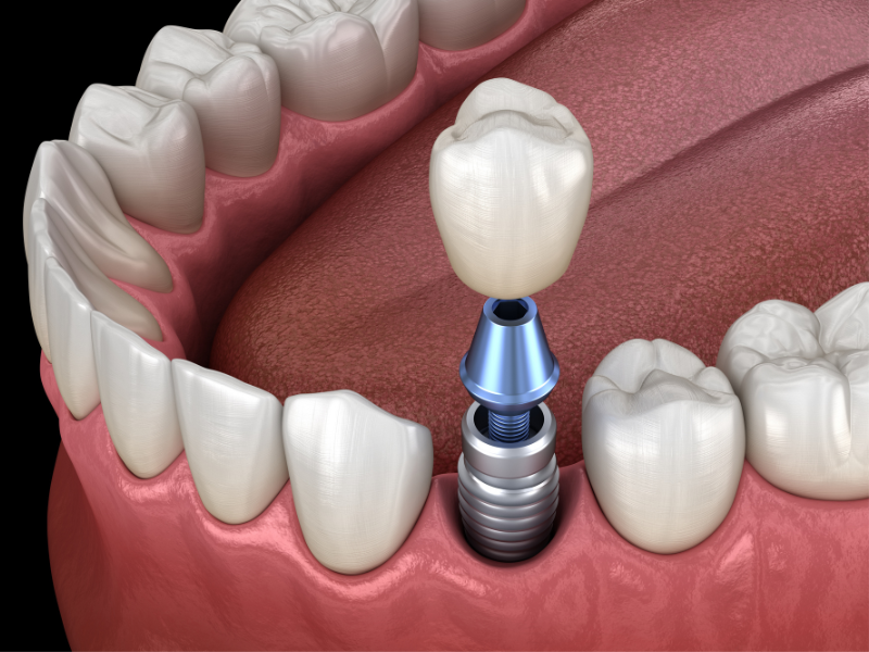 What Materials Are Dental Implants Made Of