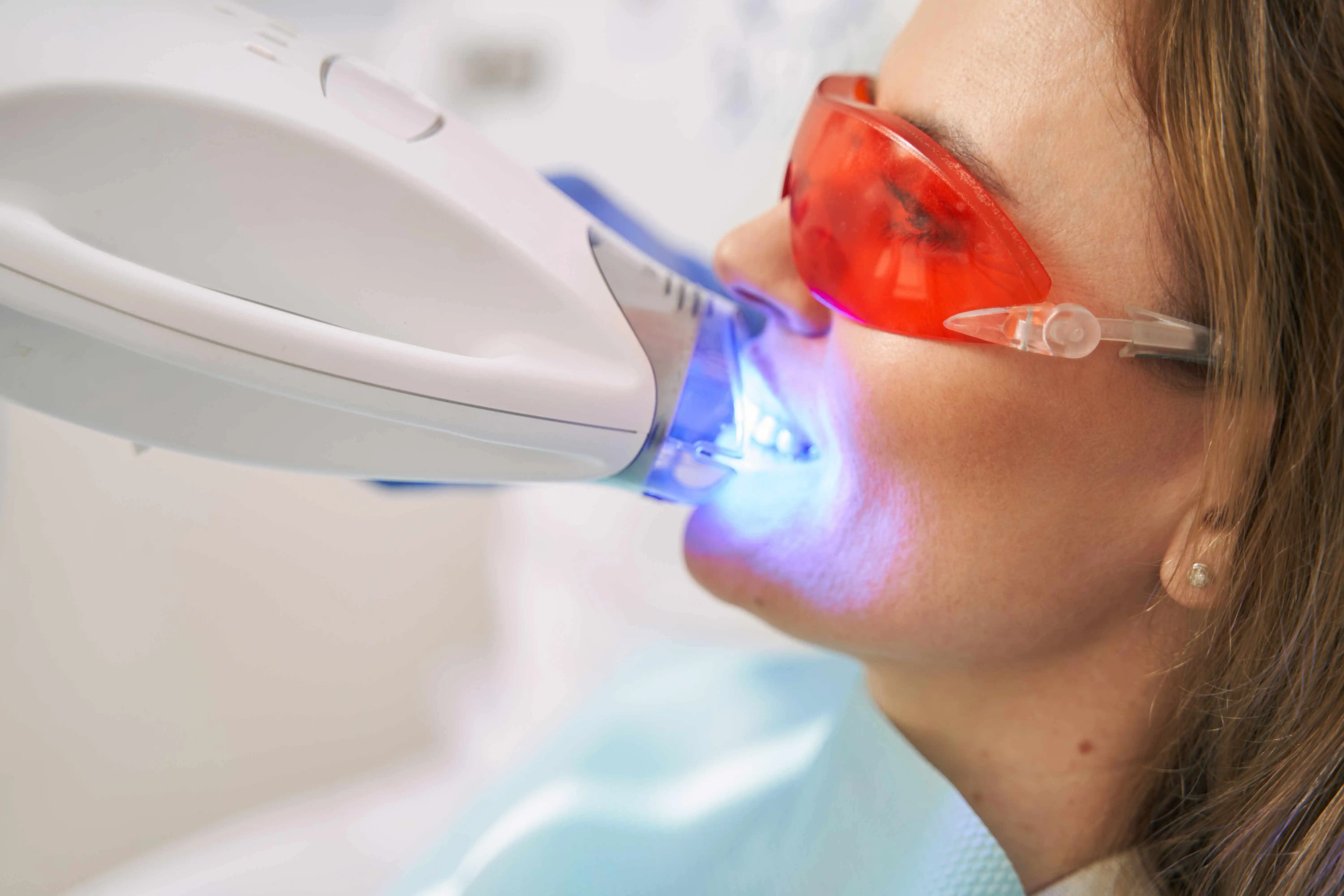 Laser Teeth-Whitening