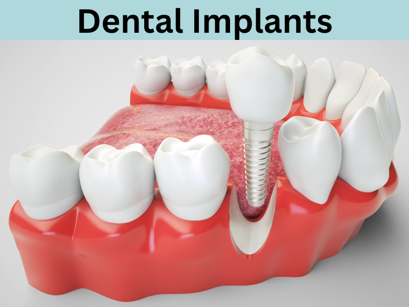 Anatomy of Dental Implants