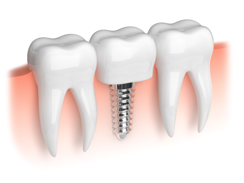 Dental Implants vs. Other Tooth Replacement Options