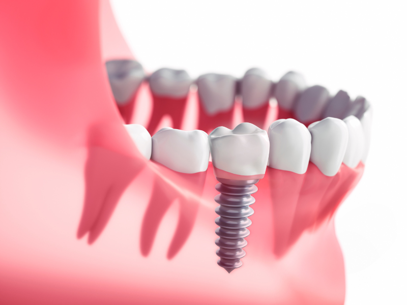 8 Facts You Don't Know About Dental Implants