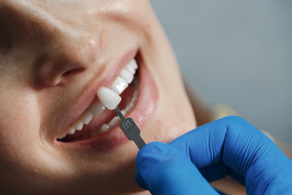 crown vs veneer