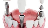 Are Dental Implants for You ?